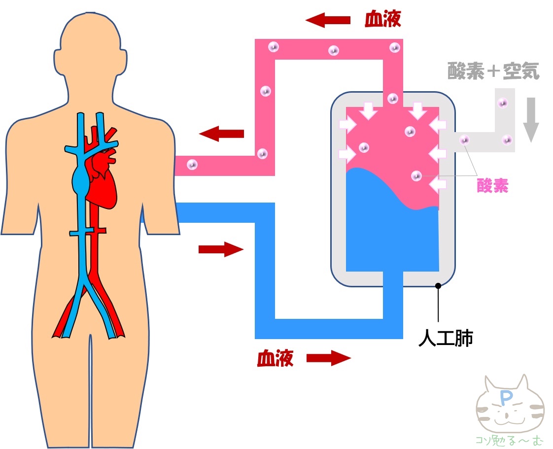 人工肺のイメージ　ぷーオリジナル　改変　